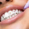 Hismile - SmileStika Fast Food Pack - 20 pcs