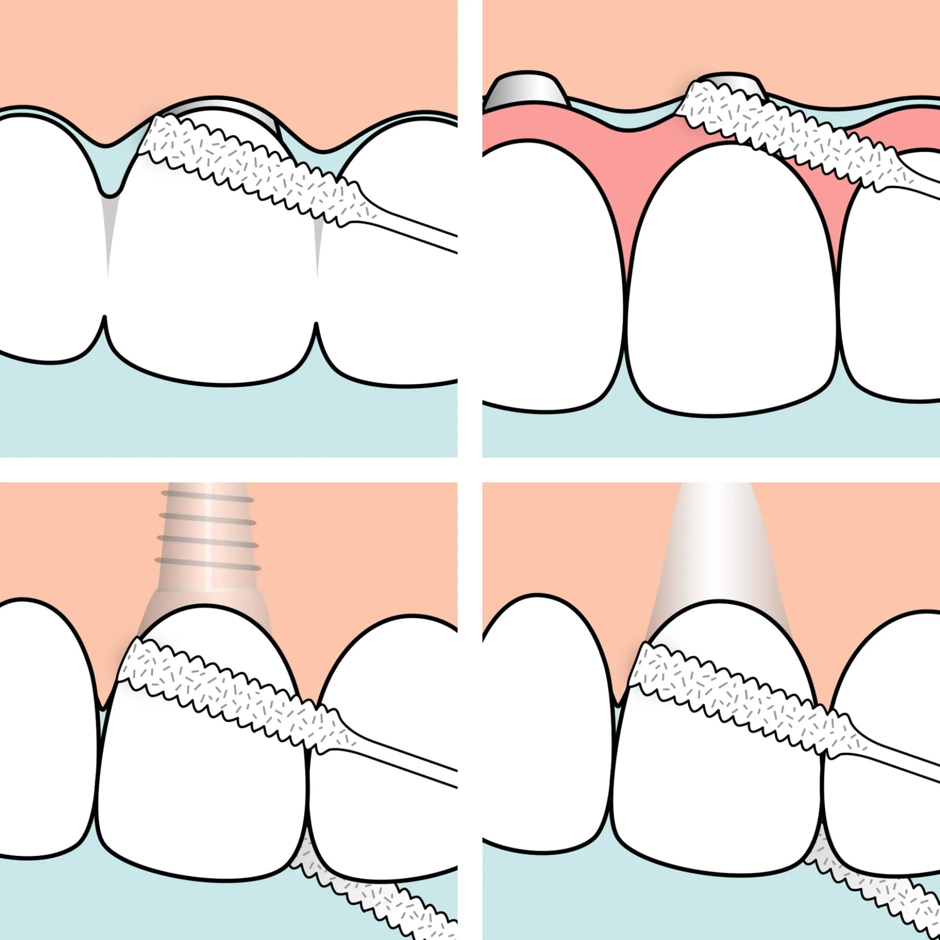 TePe Bridge & Implant Floss 30 st