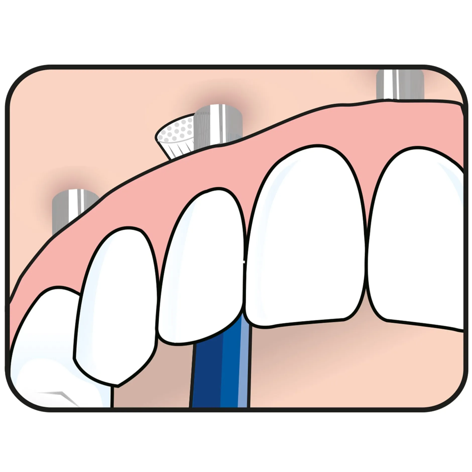 TePe Universal Care Vinklad borste 1-pack