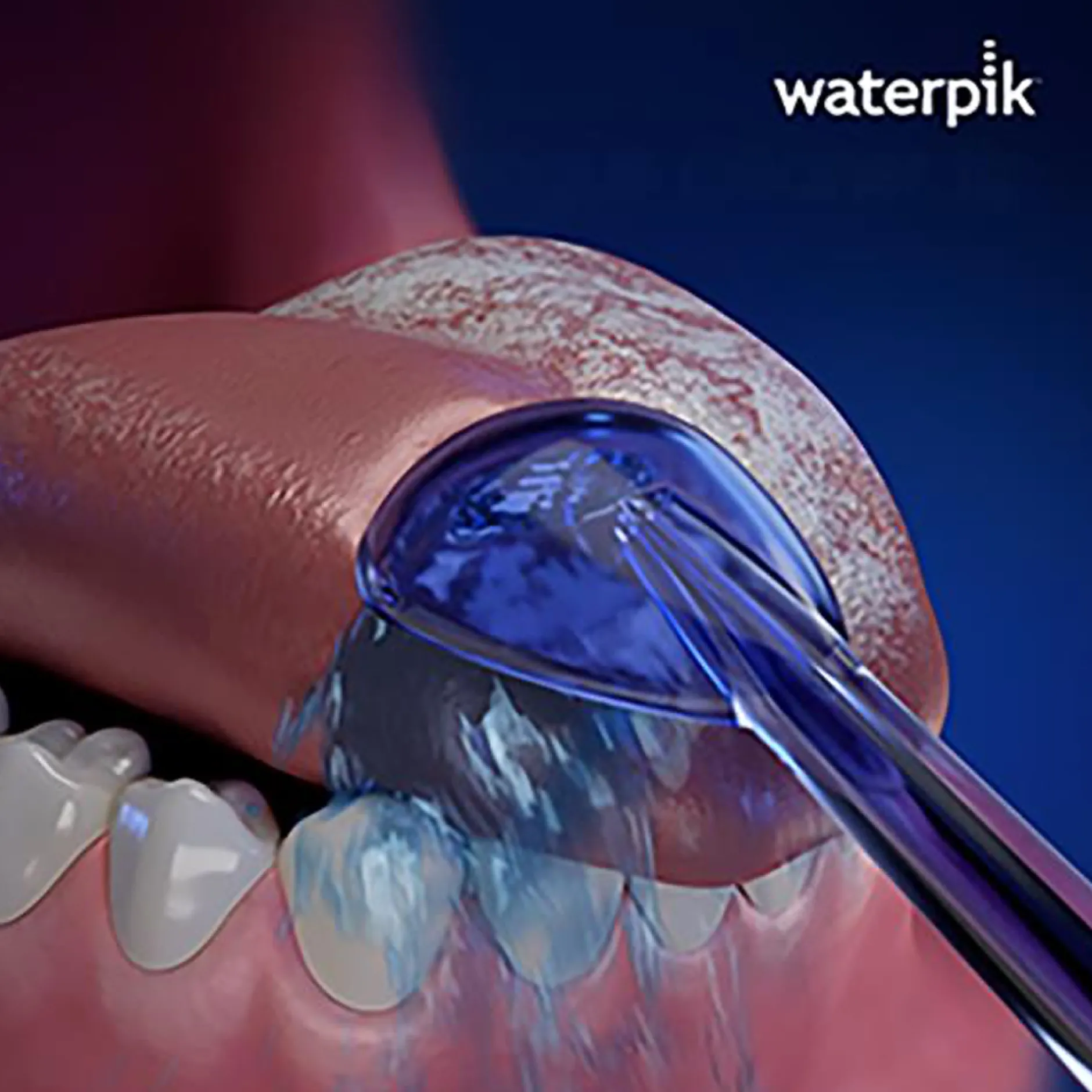 Waterpik TC-100E Water Flosser Tongue Cleaner